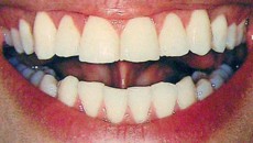 реставрация зубов, реставрация зубов красноярск