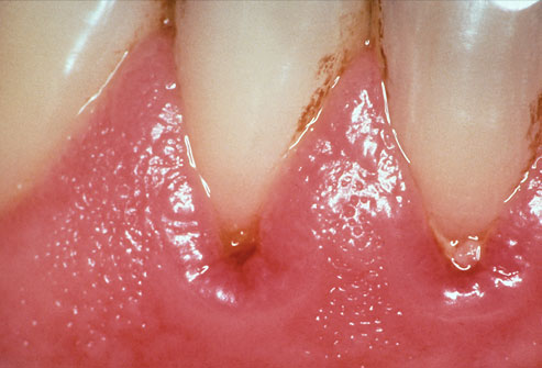 Гингивит - заболевание зубов